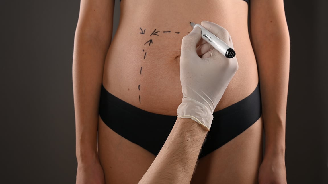 Plastic Surgery of the Female Abdomen
