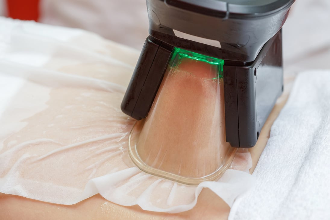 Cryolipolysis Fat Freezing Treatment